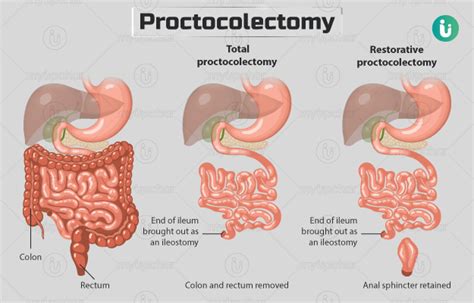 procto clean|Proctocolectomy: Definition, Types & Procedure .